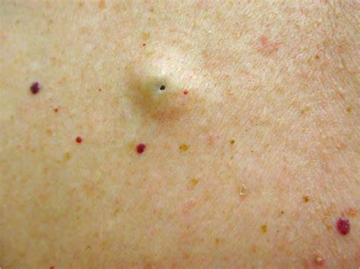 Can an inclusion cyst be cancerous?