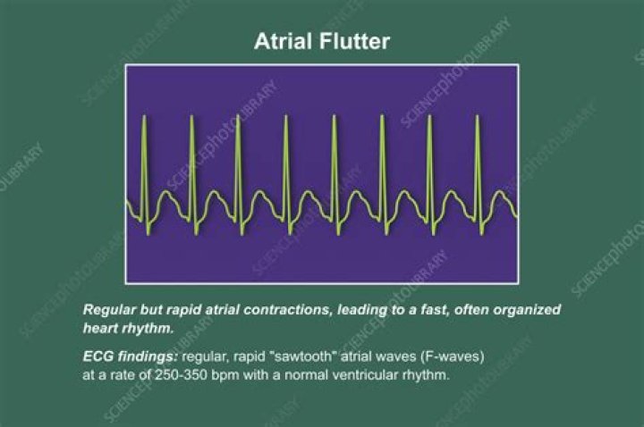 Is ventricular flutter regular?