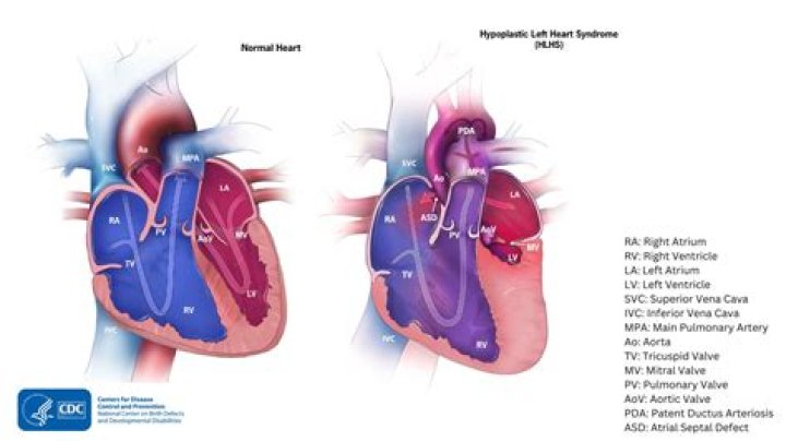 What body systems are affected by HLHS?