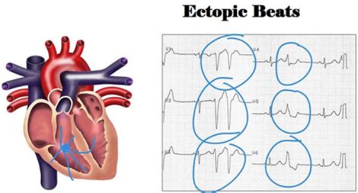 What do ectopic heartbeats sound like?