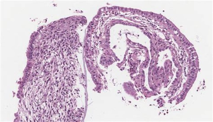What does it mean to have inactive endometrium?