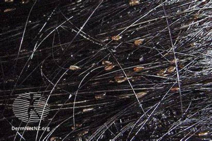 What is considered a severe lice infestation?