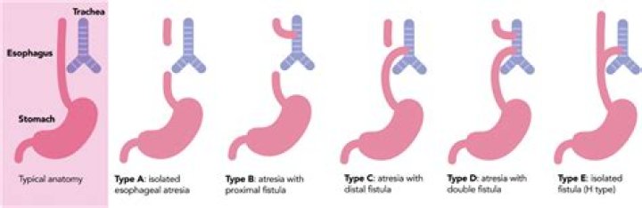 What is esophageal atresia (EA)?