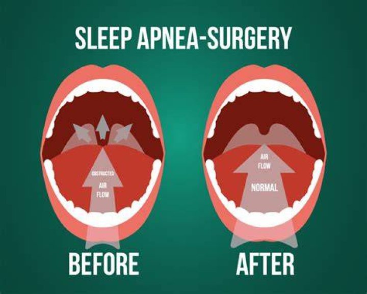 What is somnoplasty surgery?