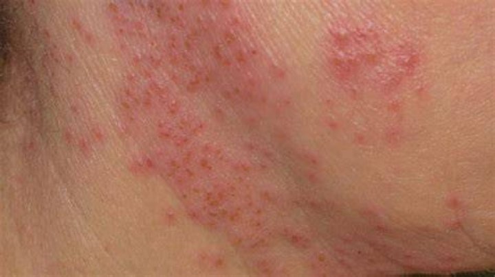What kind of rash has little blisters?