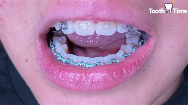 What to do if braces glue comes off?