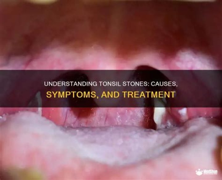 Why do tonsil stones keep coming back?